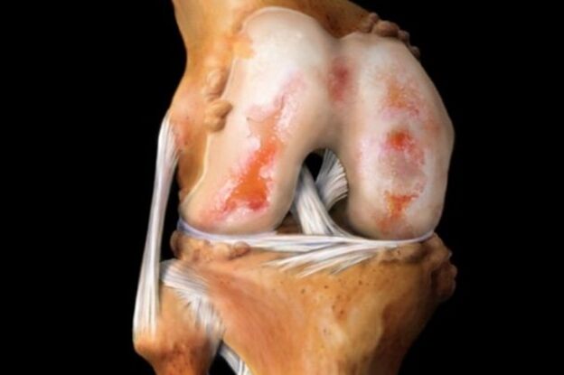 Ceļa locītavas iznīcināšana artrozes dēļ - bieži sastopama muskuļu un skeleta sistēmas patoloģija