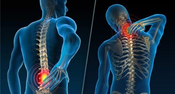 Pazīmes, kas liecina par osteohondrozes attīstību - sāpes kaklā un muguras lejasdaļā