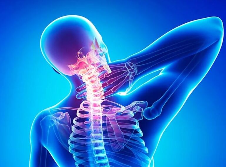 Mugurkaula kakla mugurkaula osteohondroze