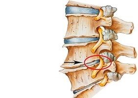 dzemdes kakla osteohondrozes cēloņi