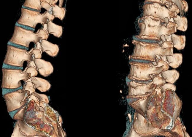 Mugurkaula jostas daļas CT skenēšana normālos apstākļos un ar osteohondrozi